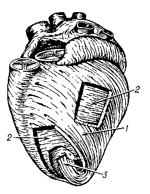 Рис. 5. Мышечные слои сердца; слева (удалены участки миокарда, чтобы показать расположение его слоев; лёгочный ствол и аорта удалены у их основания): 1 — наружный косой слой; 2 — средний круговой слой; 3 — глубокий продольный слой.
