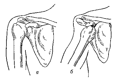 Вывих: а — нормальный плечевой сустав (правый): б — вывих правого плеча.