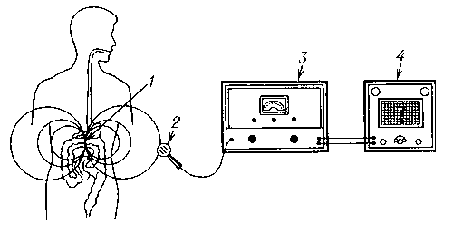 Рис. 1. Схематические изображения принципа работы радиотелеметрической системы для исследования функций пищеварительного тракта: 1 - радиопилюля в желудке; 2 - приемная антенна; 3 - радиоприемник; 4 - регистратор.