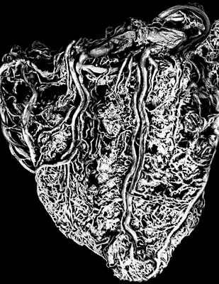 Рис. 6а. Кровеносные сосуды задней стенки здорового сердца (инъецированы цветным латексом). По С. В. Самойловой.