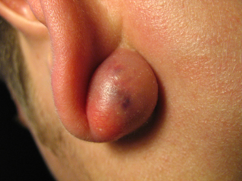 Lumps Under Skin. Epidermal cyst (Sebaceous skin