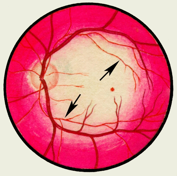 Рис. 6. Глазное дно в норме и при патологии. Непроходимость центральной артерии сетчатки: стрелками указаны суженные артерии, в центральной части глазного дна <a href=