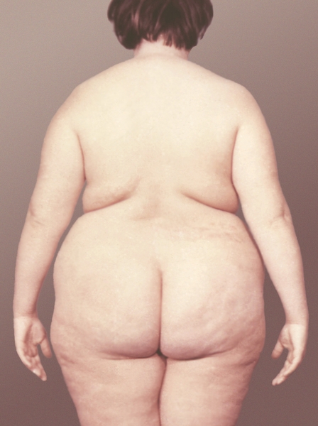 Рис. 1б). Больная с экзогенно-конституциональным ожирением: относительно равномерное распределение жировой ткани
