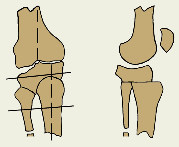 Рис. 4а). Схематическое изображение корригирующих остеотомий при гонартрозе: высокая вальгузирующая остеотомия (прямая и боковая проекции)