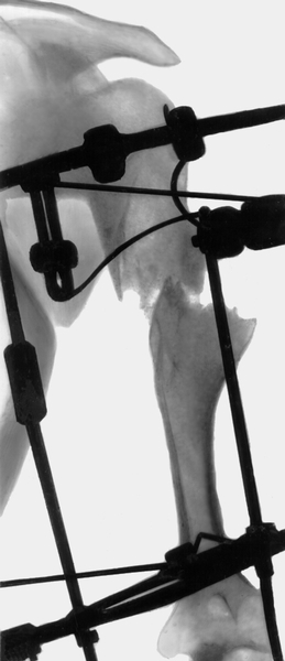 Рис. 38б). Рентгенограмма плечевой кости при дисхондроплазии в процессе лечения: деформация устранена путем кортикотомии через <a href=