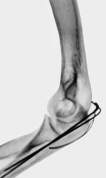 Рис. 10б). Рентгенограмма локтевого сустава (боковая проекция) при переломе локтевого отростка с расхождением отломков — после остеосинтеза спицами и проволокой