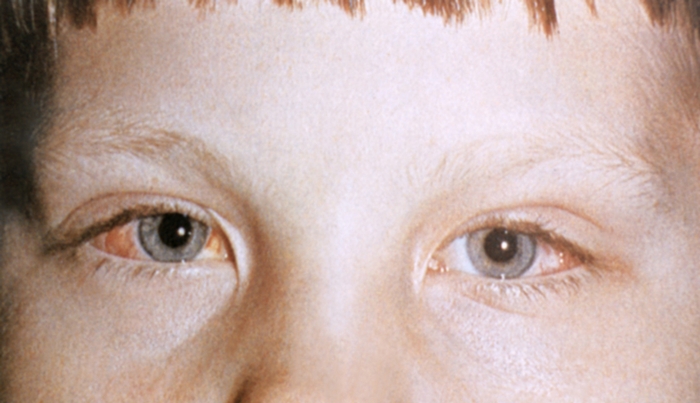 Глаза ребенка с врожденным эпикантусом