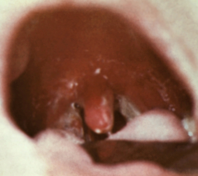 Рис. 2. Распространенная дифтерия ротоглотки: серовато-белые отторгающиеся налеты на гиперемированных с цианотичным оттенком небных миндалинах, дужках и язычке