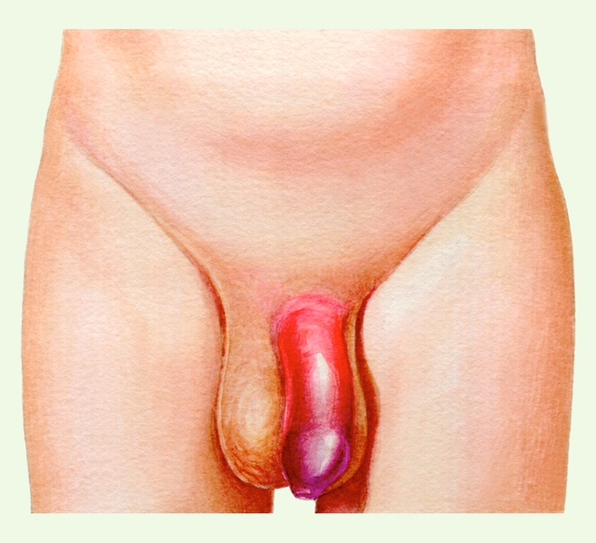 Рис. 4а). Наружные половые органы при травме полового члена без разрыва уретры: ограниченный отек и гиперемия кожи полового члена