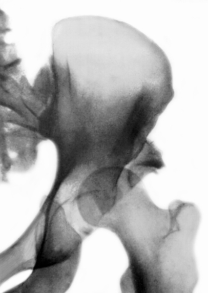 Рис. 13б). Рентгенограмма тазобедренного сустава (прямая проекция) при переломовывихе левого бедра с повреждением вертлужной впадины
