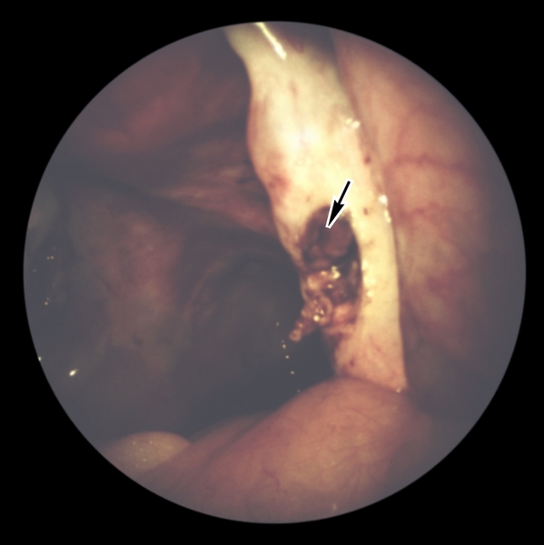 Рис. 3. Лапароскопическая картина поликистозного яичника после проведения биопсии: виден <a href=