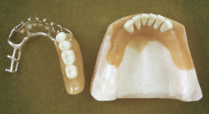 Рис. 13. Бюгельный шинирующий протез на нижнюю челюсть, применяемый при дефекте зубных рядов
