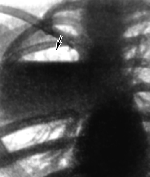Рис. 2а). Рентгенограмма грудной клетки при абсцессе правого легкого, произведенная в ортопозиции: в верхней доле легкого определяется большая полость, содержащая газ (указана стрелкой) и жидкость, образующая горизонтальный уровень