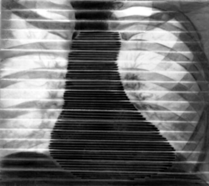 Рис. 1. Рентгенокимограмма сердца (передняя проекция): <a href=