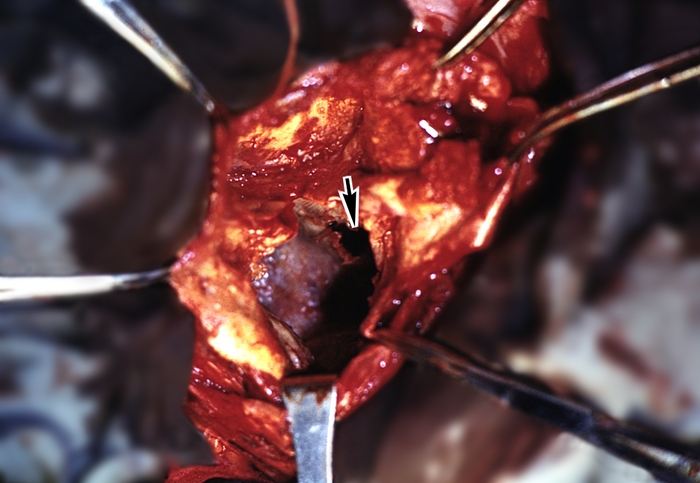 Рис. 6. Этап оперативного вмешательства при альвеолярном эхинококкозе печени: стрелкой указан паразитарный узел с полостью распада