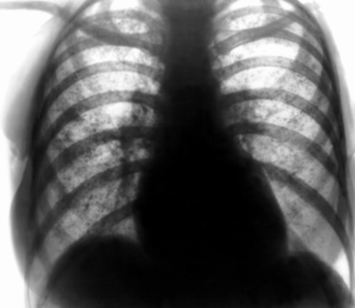 Рис. 4. Обзорная рентгенограмма грудной клетки при металлокониозе: видны мельчайшие узелковые тени высокой интенсивности в обоих легочных полях