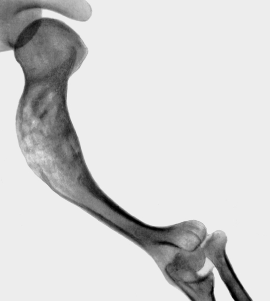 Рис. 38а). Рентгенограмма плечевой кости при дисхондроплазии в процессе лечения: до операции плечевая кость деформирована
