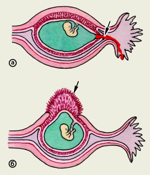Рис. 2. Схематическое изображение внутреннего (а) и наружного (б) разрыва плодовместилища при ампулярной трубной беременности (участки разрывов указаны стрелками)