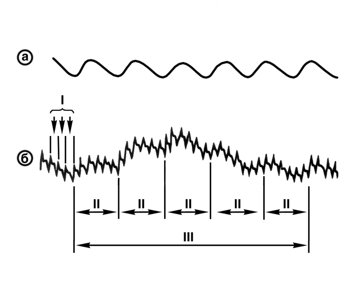 Рис. 2. Синхронно зарегистрированные пневмограмма (а) и пальцевая плетизмограмма (б): l — волны первого порядка, или объемный пульс (указаны стрелками); II — волны второго порядка, имеющие период дыхательных волн, изображенных на пневмограмме (a); III — волна третьего порядка, имеющая период нескольких дыхательных волн