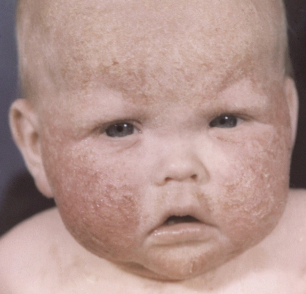 Рис. 6. Эритема, папулезно-везикулезные высыпания на лице ребенка, страдающего экземой