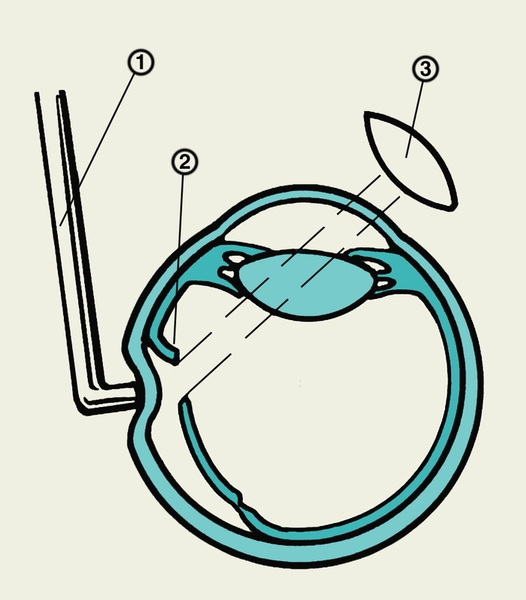 Рис. 1. Схема определения локализации разрыва сетчатки при бинокулярной офтальмоскопии: 1 — <a href=