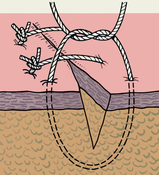 Рис. 1. Схематическое изображение наложения простого узлового шва на линейную кожную рану