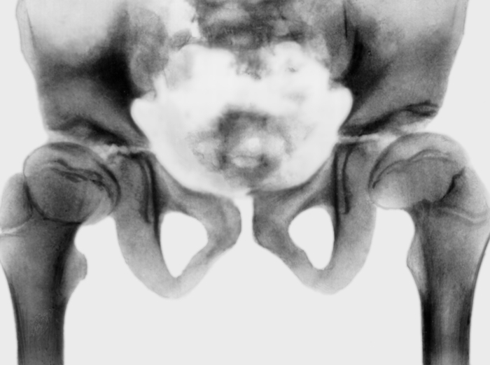 Рис. 29. Рентгенограмма тазобедренных суставов при поздней спондилоэпифизарной дисплазии: уплощение эпифизов бедренных костей, их поперечник больше метафизарной пластинки, а шейки укорочены и расширены
