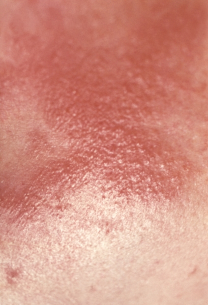 Рис. 5б). Аллергический дерматит, вызванный мазью, содержащей ментол: везикуло-папулезные высыпания на эритематозном фоне на коже живота и молочной железе, <a href=