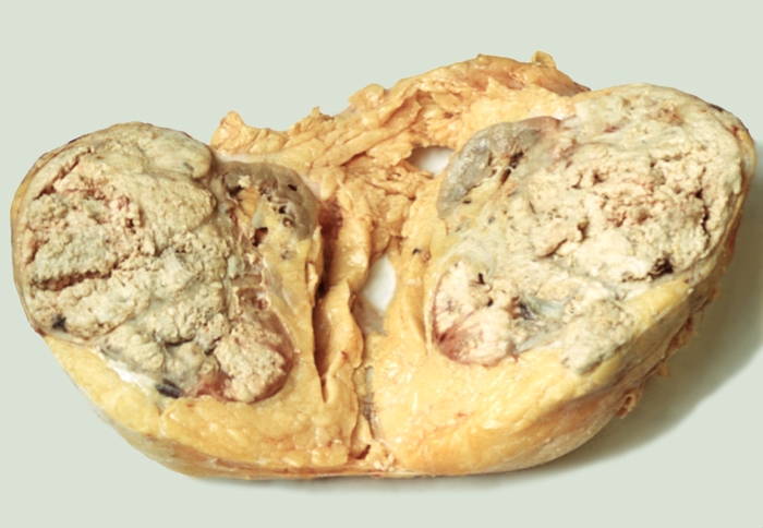 Макропрепарат почки при нефробластоме: на разрезе виден крупный опухолевый узел с участками некроза, четко отграниченный от почечной паренхимы