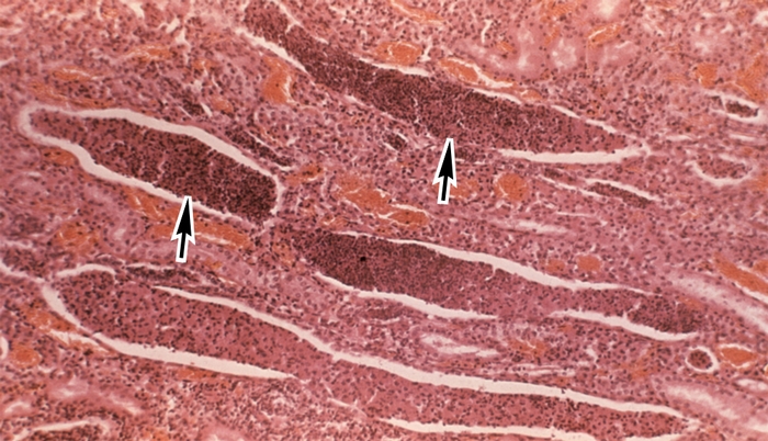 Рис. 3а). Микропрепарат почки при остром гнойном пиелонефрите: белково-лейкоцитарные цилиндры в почечных канальцах (указаны стрелками); ×80
