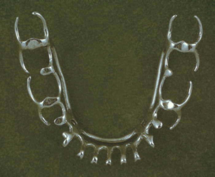 Рис. 14. Бюгельный шинирующий протез на нижнюю челюсть, применяемый при наличии всех зубов