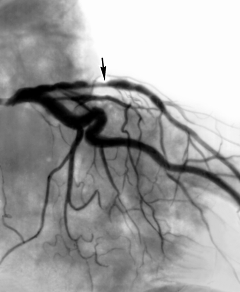 Рис. 1а). Коронарограммы при стенозе передней межжелудочковой ветви левой венечной артерии до рентгеноэндоваскулярной дилатации (стрелкой показано место стеноза)