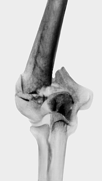 Рис. 8. Рентгенограмма локтевого сустава (передне-задняя проекция) при чрезмыщелковом оскольчатом переломе плечевой кости