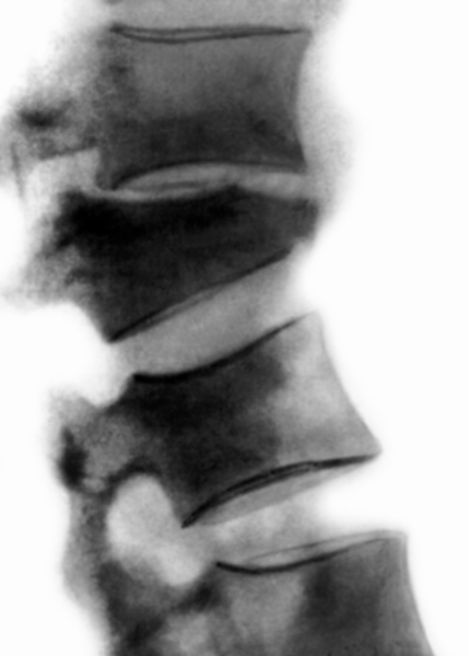 Рис. 10б). Рентгенограмма поясничного отдела позвоночника (боковая проекция) при компрессионном переломе с тяжелой степенью компрессии