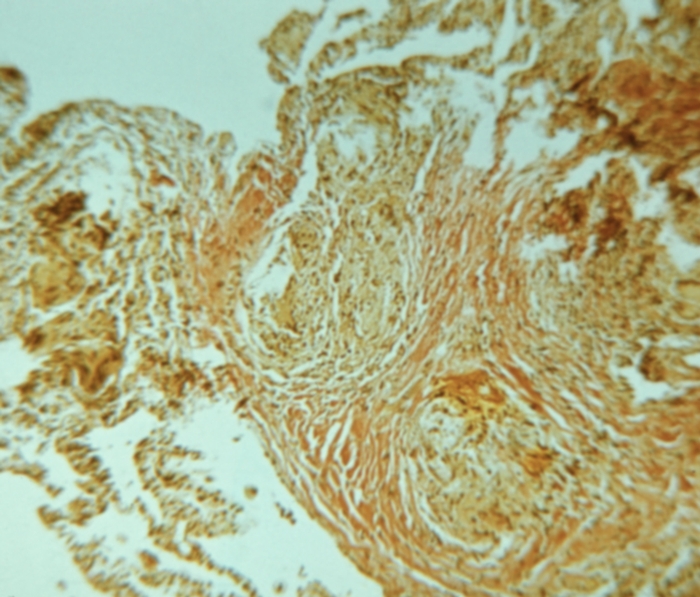 Рис. 2. Микропрепарат легкого при саркоидозе легких (материал биопсии): саркоидные гранулемы (указаны стрелками), окруженные кольцевидными полями фиброза; окраска по Ван-Гизону; ×200