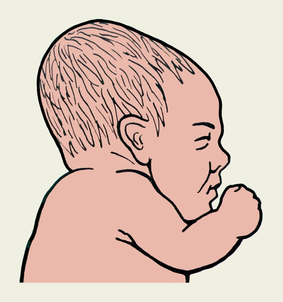 Рис. 8. Долихоцефалическая форма головки плода, образовавшаяся в результате родов при затылочном его предлежании