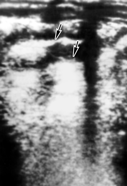 Рис. 8. Ультразвуковая сканограмма кишечника при болезни Крона: стенка кишки (справа) значительно утолщена, просвет кишки сужен, остальная часть кишки не изменена (область поражения указана стрелками)