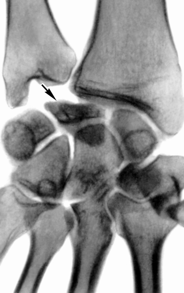Рис. а). Рентгенограмма лучезапястного сустава при III стадии болезни Кинбека (прямая проекция); деформация полулунной кости в зоне контакта с лучевой костью