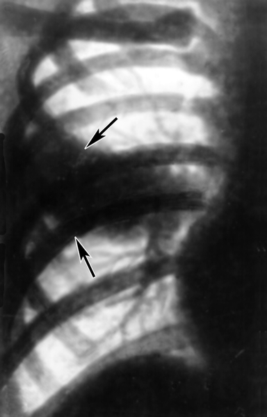 Рис. б). Рентгенограмма правой половины грудной клетки больного орнитозной пневмонией (передняя прямая проекция): стрелками указана треугольная тень сегментарного инфильтрата