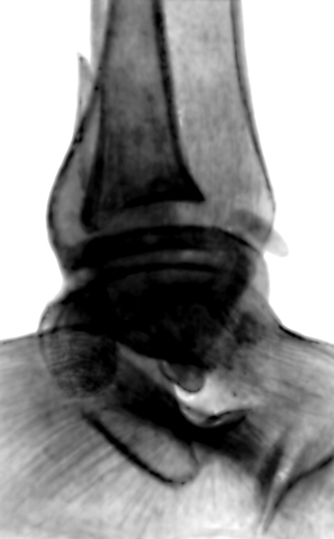 Рис. 4г). Рентгенограмма голеностопных суставов при переломах образующих их костей: перелом наружной и внутренней лодыжек со смещением (боковая проекция)