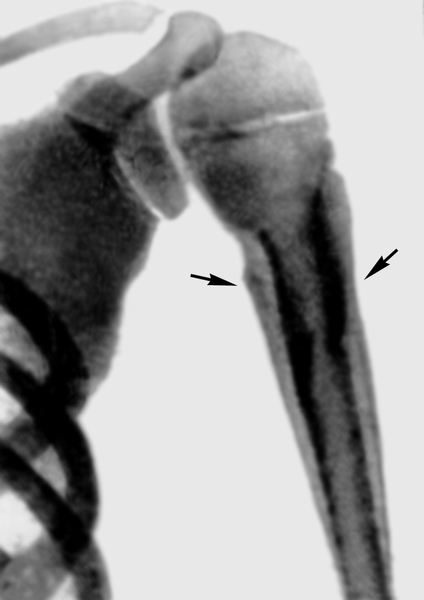 Рис. 2. Рентгенограмма плечевой кости ребенка 10 лет при хроническом остеомиелите в стадии обострения (прямая проекция): линейные тени периостальных наслоений (указаны стрелками) в проксимальном отделе плечевой кости
