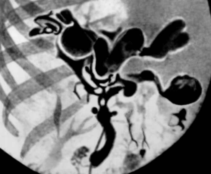 Рис. 7. Интраоперационная холангиограмма при болезни Кароли (прямая проекция): выявляются кистозно-расширенные внутрипеченочные крупные желчные протоки