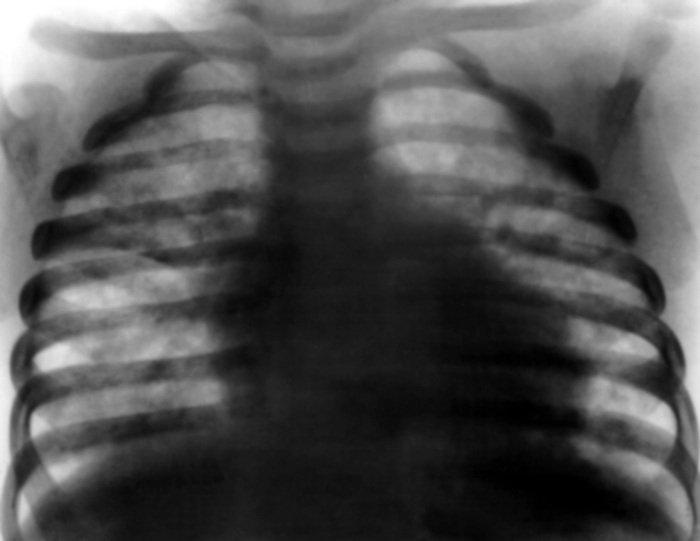Рентгенограмма грудной клетки ребенка 1 года с врожденным комбинированным иммунодефицитом и пневмоцистозом: диффузные изменения в обоих легких (на фоне усиленного интерстициального рисунка легких видны множественные нечетко очерченные, местами сливающиеся тени)