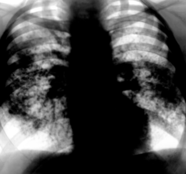 Рис. 4. Рентгенограмма грудной клетки при саркоидозе легких и внутригрудных лимфатических узлов: расширенные тени легочных корней формируются в основном увеличенными лимфатическими узлами, в средних и частично в нижних легочных полях видны множественные, местами сливающиеся очаговоподобные тени (картина диссеминации); прозрачность легких в области верхушек сохранена