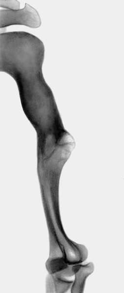 Рис. 38г). Рентгенограмма плечевой кости при дисхондроплазии в процессе лечения: отдаленный результат лечения — деформация устранена