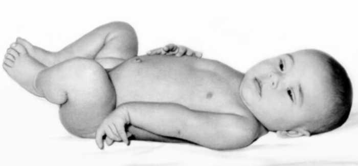 Рис. 3. Ребенок с верхним проксимальным типом пареза плечевого сплетения (Дюшенна —Эрба)