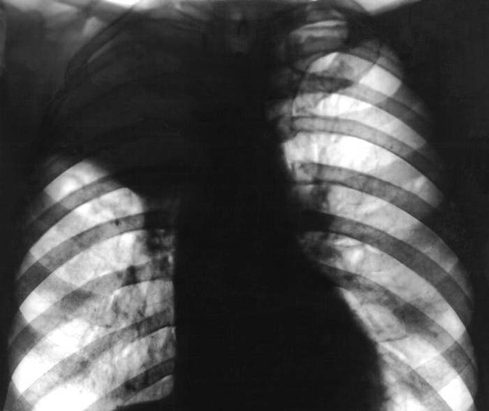 Рис. 2а). Рентгенограмма грудной клетки при ателектазе верхней доли правого легкого (прямая проекция): верхняя доля правого легкого уменьшена в объеме, гомогенно затенена