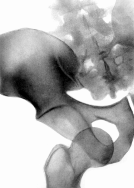 Рис. 13а). Рентгенограмма тазобедренного сустава (прямая проекция) при травматическом вывихе правого бедра