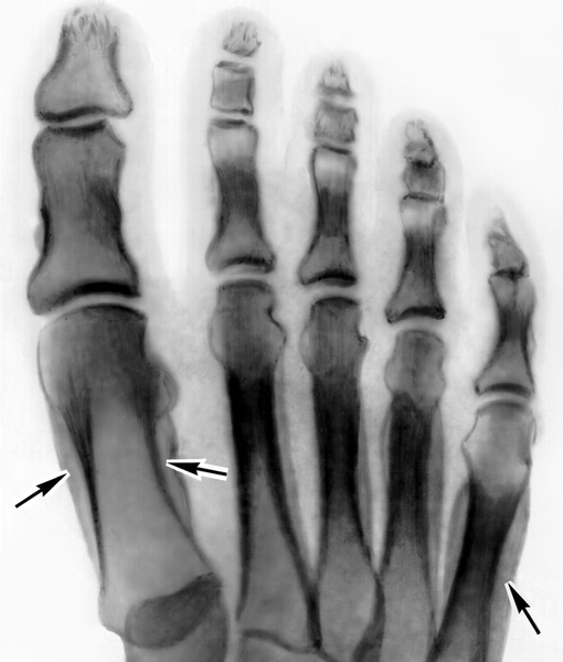 Рентгенограмма стопы больного периостозом Бамбергера — Мари: стрелками указаны периостальные наслоения костей