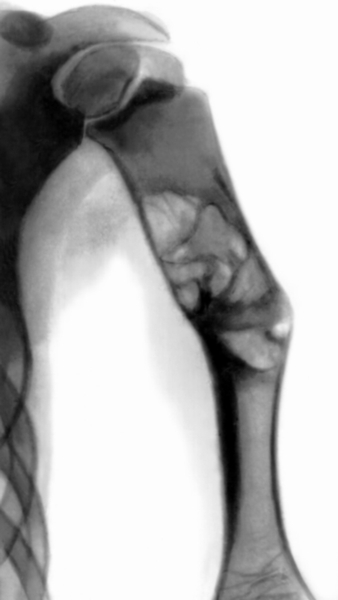 Рис. 2в). Динамика развития солитарной кисты кости: солитарная киста в фазе восстановления у того же больного через 1 год, на месте кисты несколько меньших полостей, между кистой и зоной роста нормальная кость